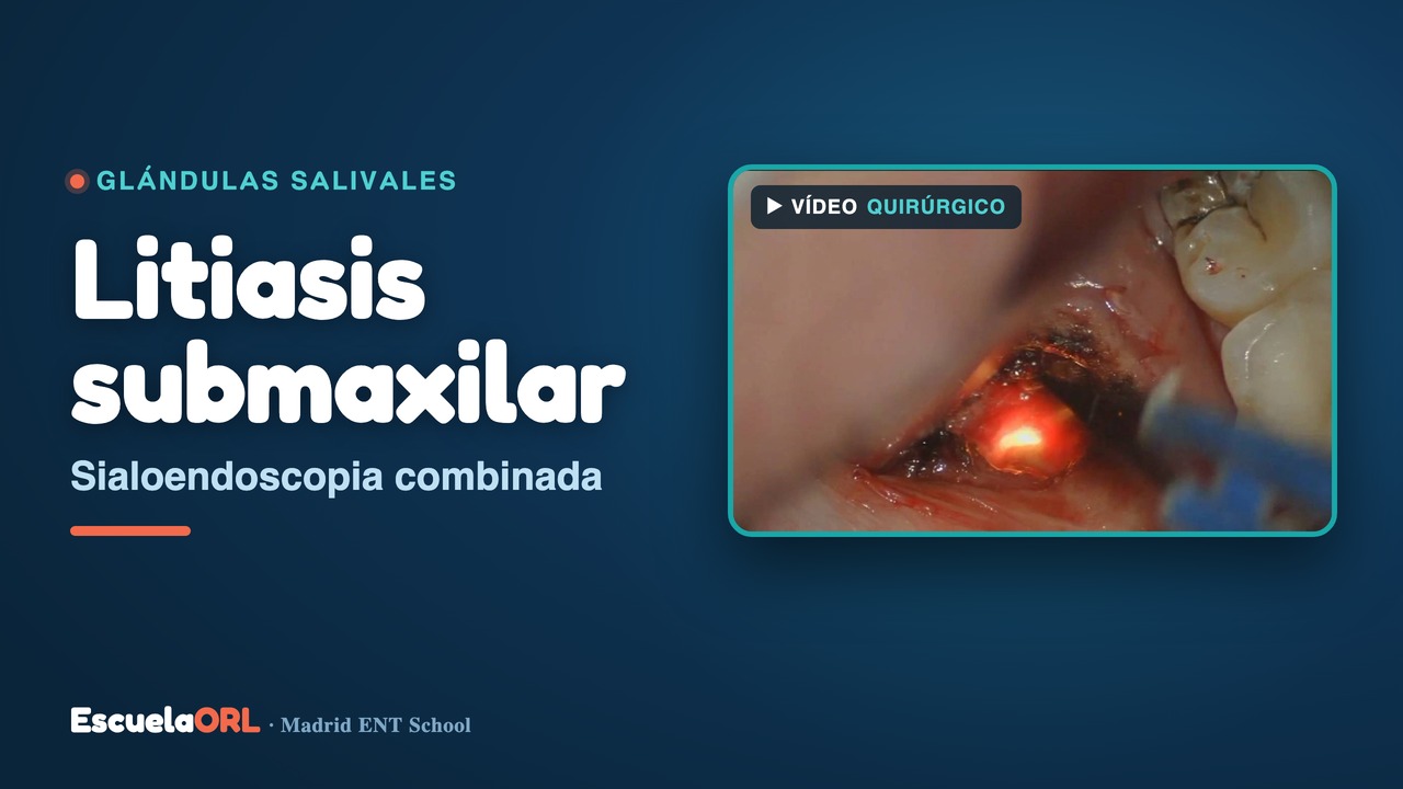 Miniatura del vídeo "Extracción de Litiasis hiliar por Sialendoscopia"