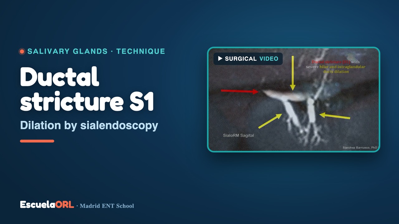 Miniatura del vídeo Dilation of S1 ductal stricture by sialendoscopy