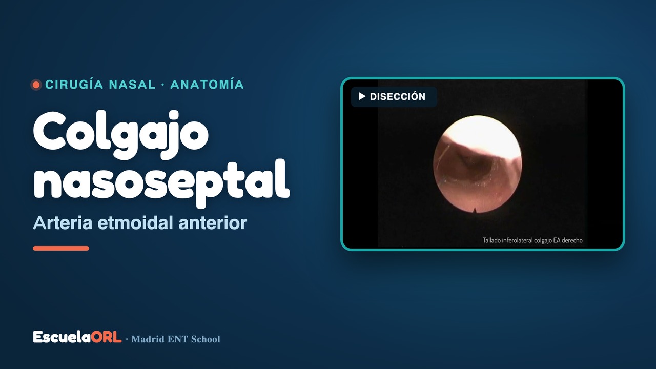 Miniatura del vídeo Colgajo nasoseptal de arteria Etmoidal Arterial (EA)