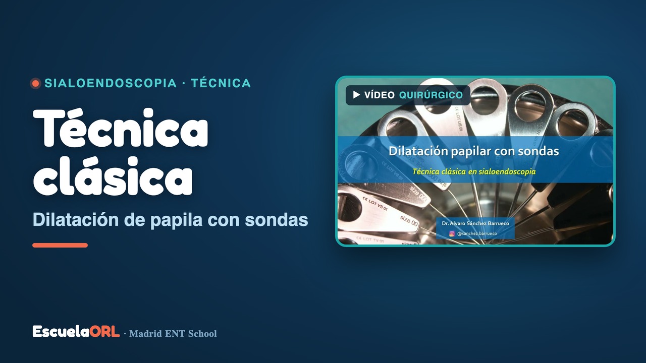 Miniatura del vídeo Dilatación de papila previa a sialoendoscopia (Técnica Clásica)