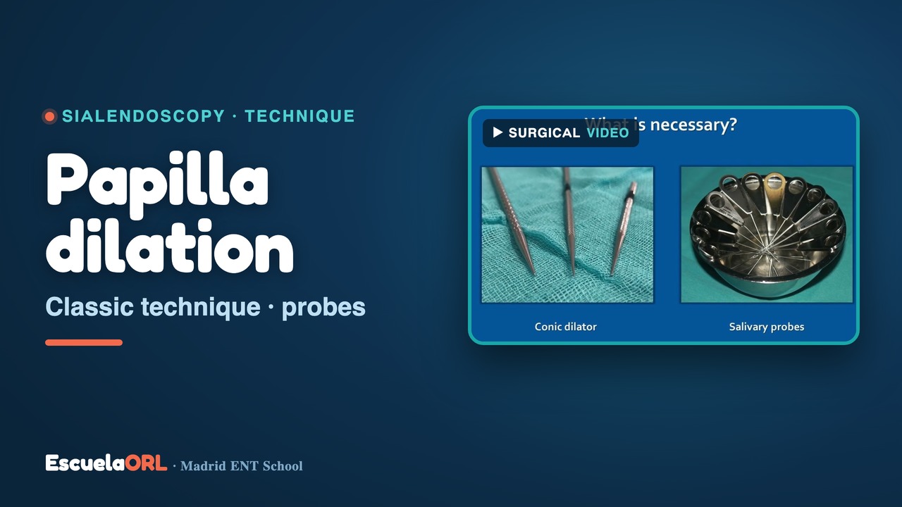 Miniatura del vídeo Dilation of salivary gland papilla with probes (classic technique in sialendoscopy)