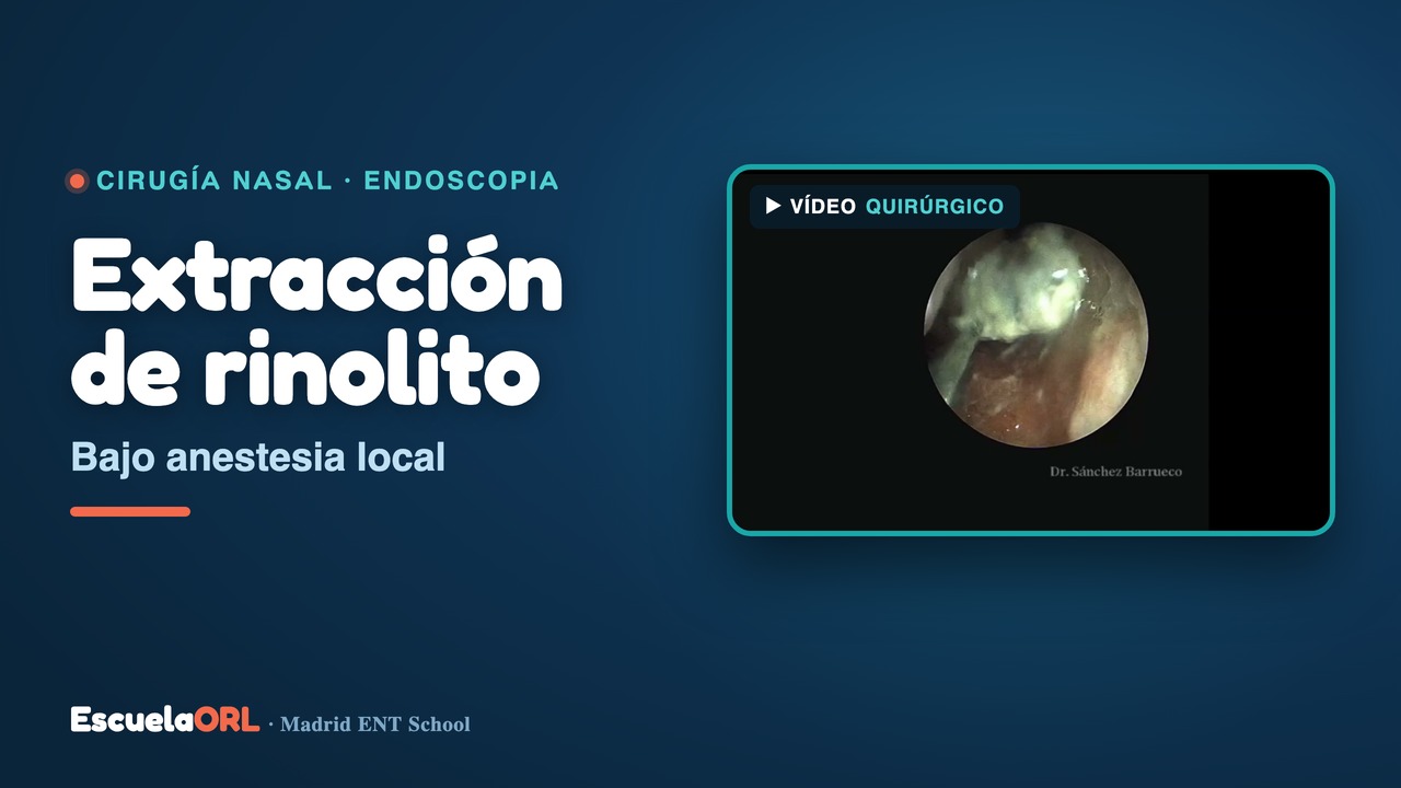 Miniatura del vídeo Extraccion de rinolito (cuerpo extraño nasal) bajo anestesia local
