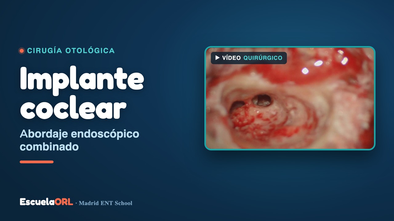Miniatura del vídeo Intervención 4: Colocación de Implante Coclear mediante abordaje combinado endoscópico