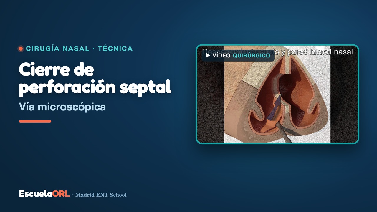 Miniatura del vídeo Cierre de perforación de tabique nasal por vía microscópica