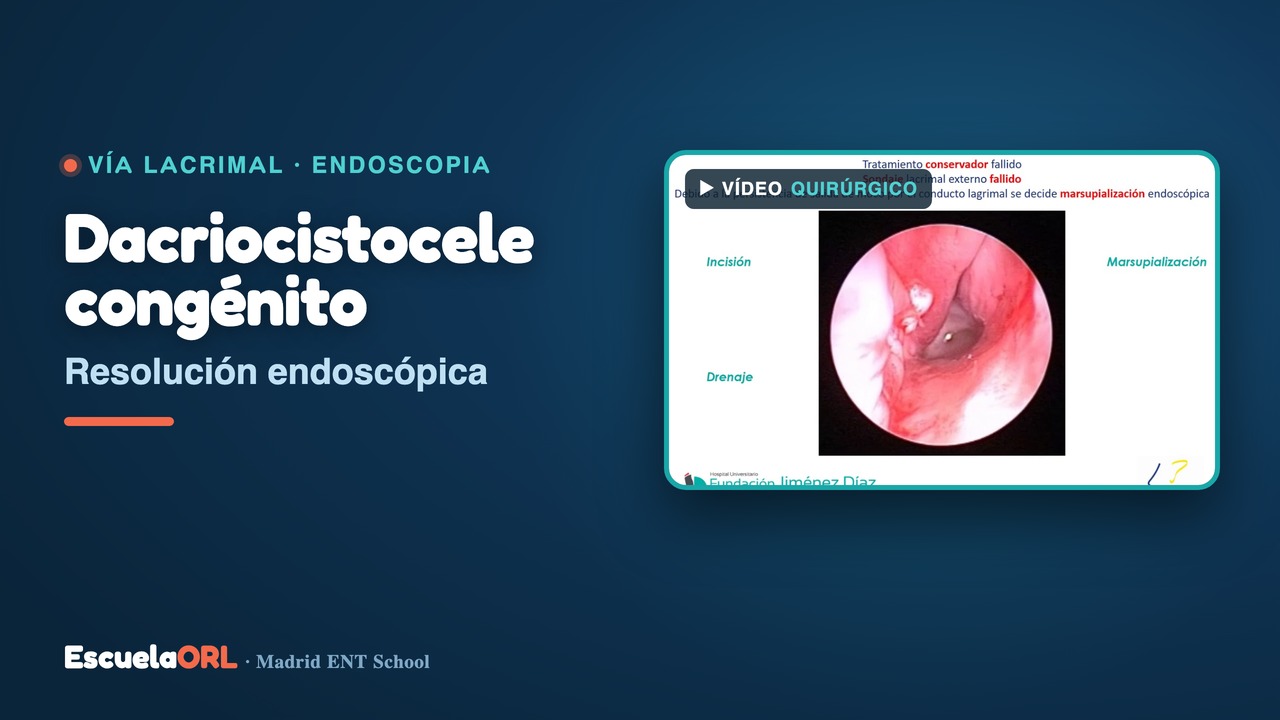 Miniatura del vídeo Resolución endoscópica de dacriocistocele congénito
