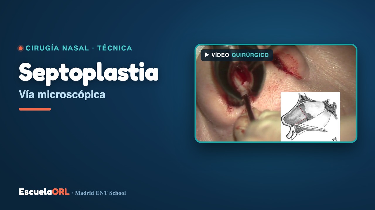 Miniatura del vídeo Septoplastia por vía microscópica