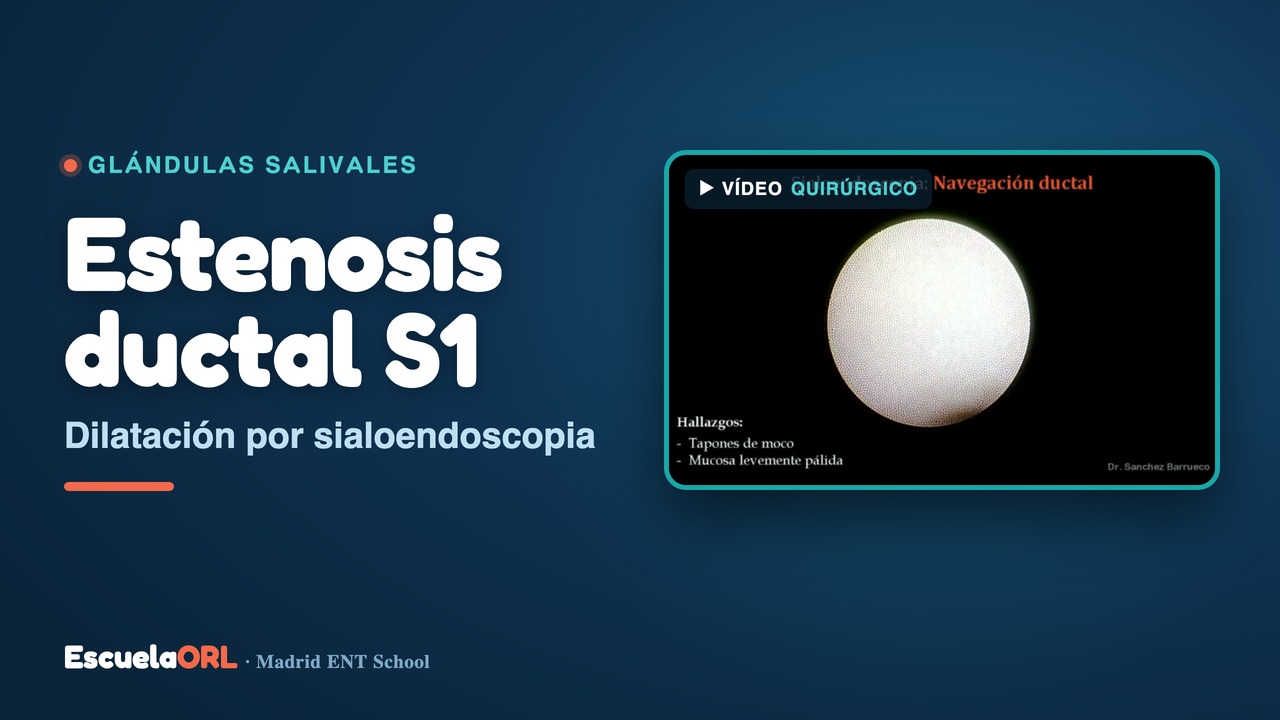 Miniatura del vídeo Sialoendoscopia con dilatación de estenosis ductal S1