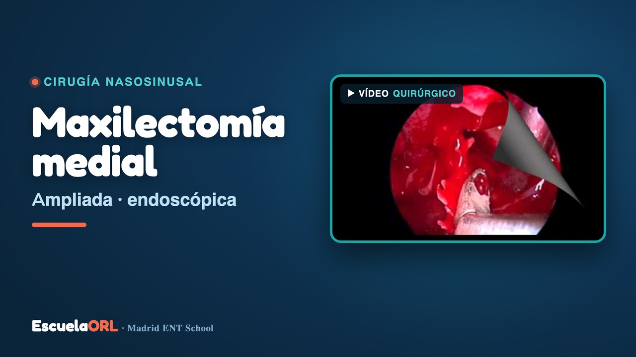 Miniatura del vídeo Maxilectomía Medial Ampliada