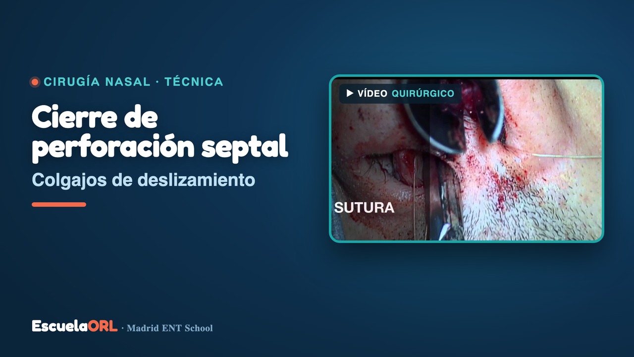 Miniatura del vídeo Perforación tabique