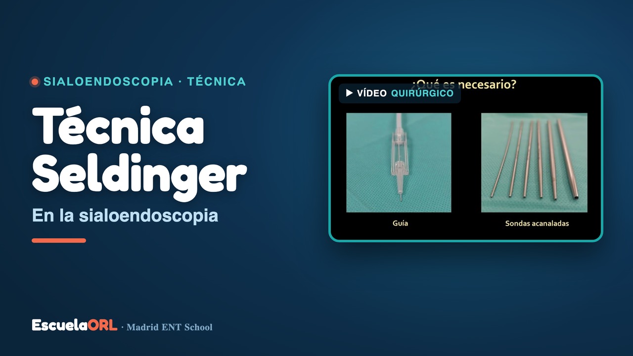 Miniatura del vídeo Técnica Seldinger en la sialoendoscopia