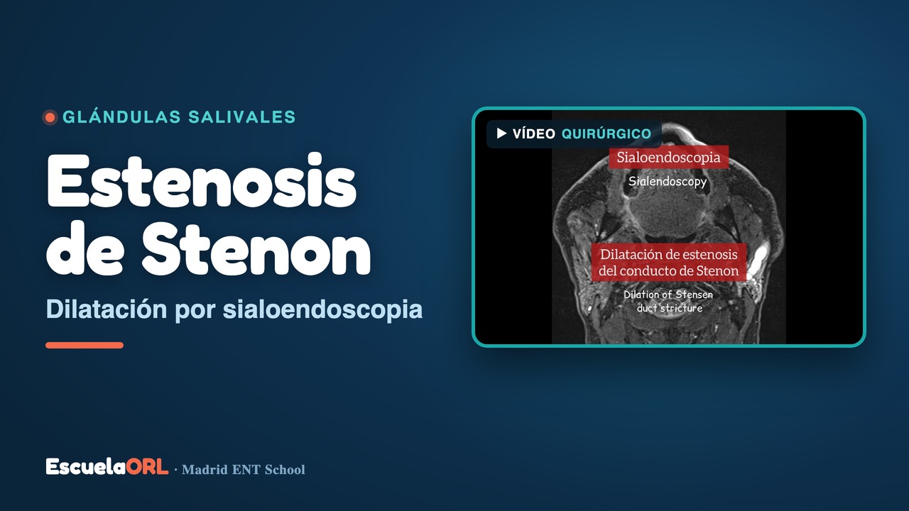 Miniatura del vídeo Dilatación de estenosis del conducto de Stenon mediante sialoendoscopia.