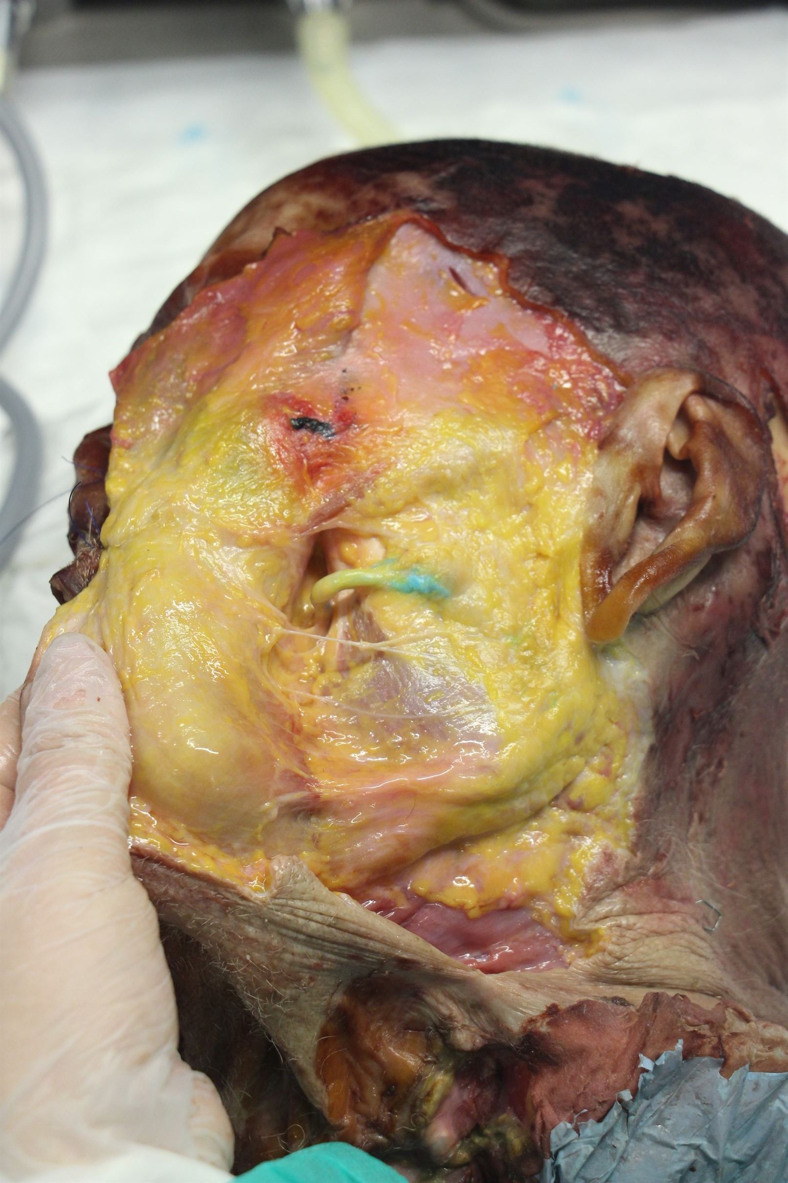 Sialoendoscopia 6 nuevo
