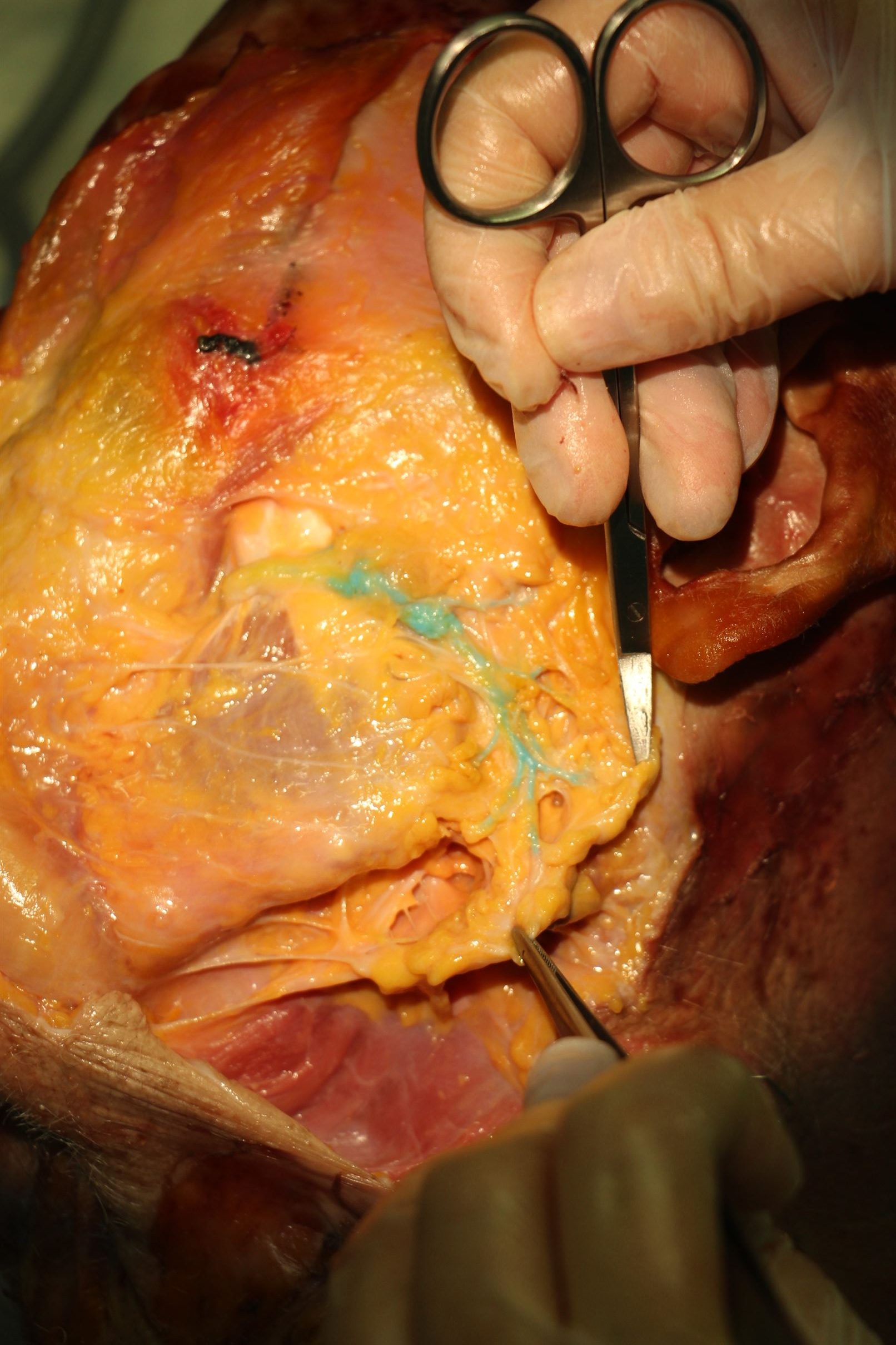 Sialoendoscopia 5 nuevo