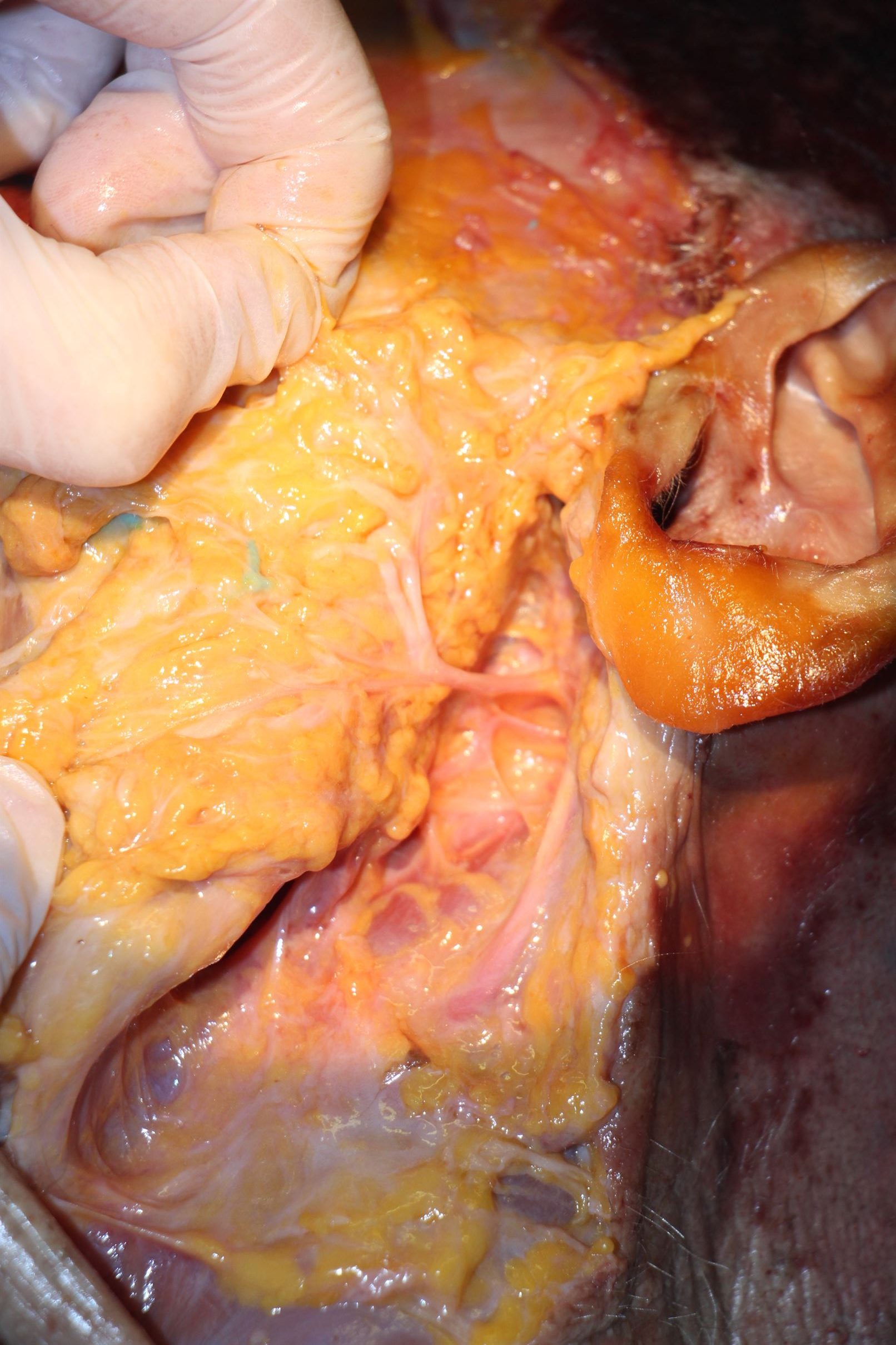 Sialoendoscopia 4 nuevo