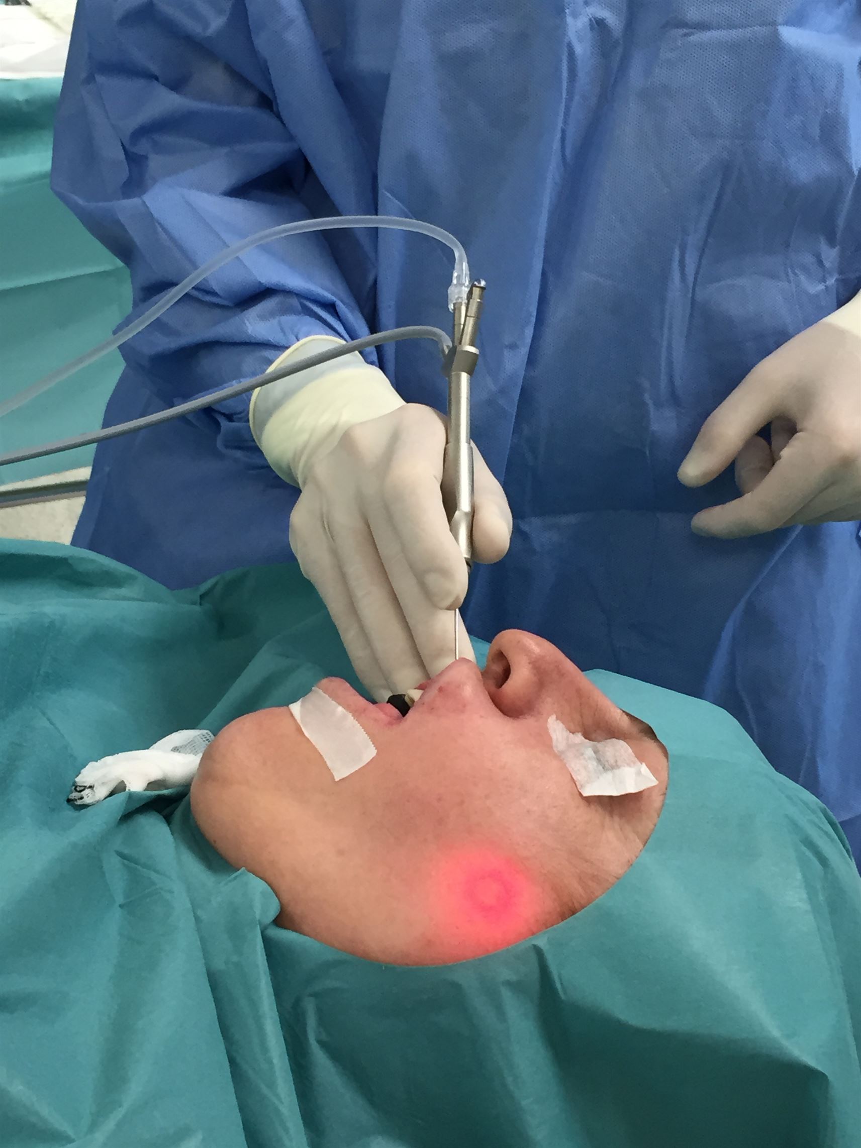 Sialoendoscopia 2 nuevo